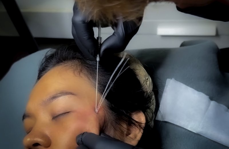 Patient after non-surgical anti-aging treatment in Dubai