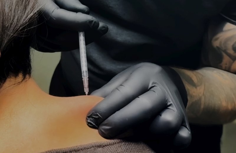 Subtle sculpting of lower face with dermal filler injections