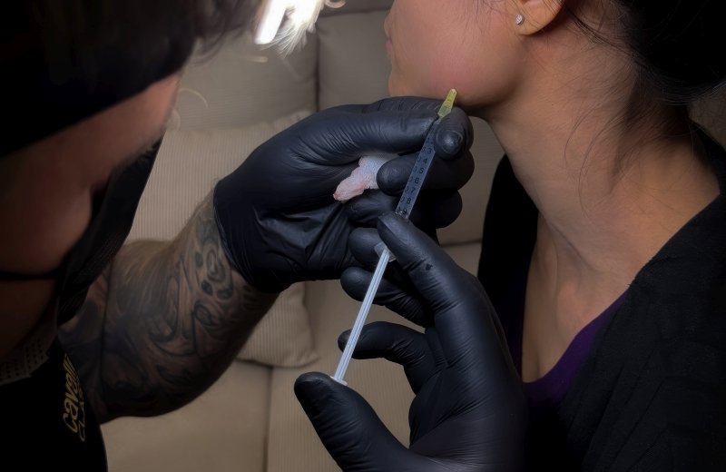 Restoring definition with jawline and chin filler procedures