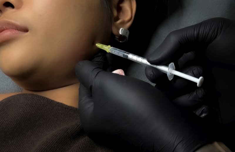 Forehead lines smoothed with advanced botox technique in Dubai