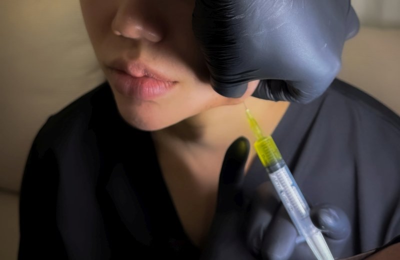 Jawline contouring to restore youthful facial definition