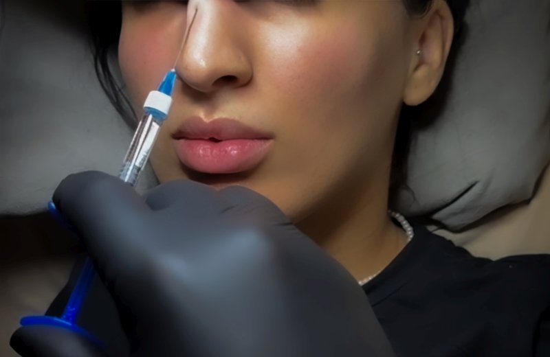 Aesthetic doctor preparing botulinum toxin for forehead treatment